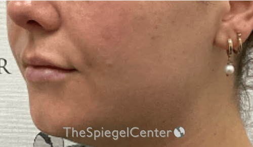 Lip Filler Before & After Gallery - Patient 487275 - Image 6