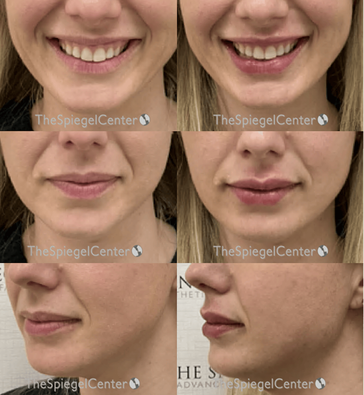 Lip Filler Before & After Gallery - Patient 383477 - Image 1