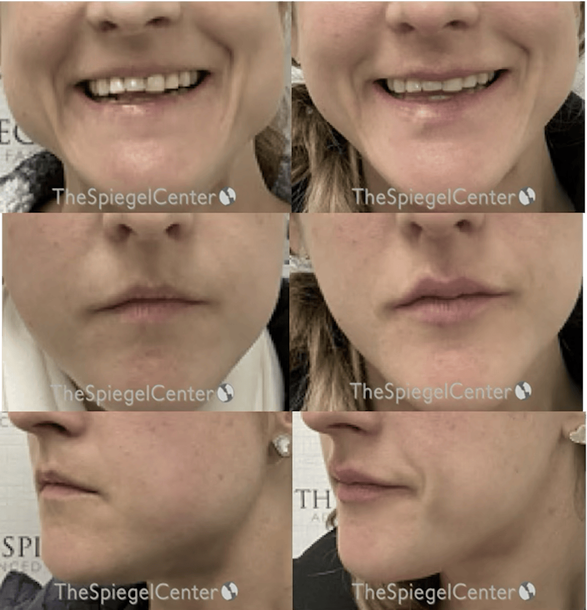 Lip Filler Before & After Gallery - Patient 255029 - Image 1