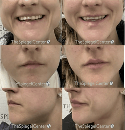 Lip Filler Before & After Gallery - Patient 255029 - Image 1