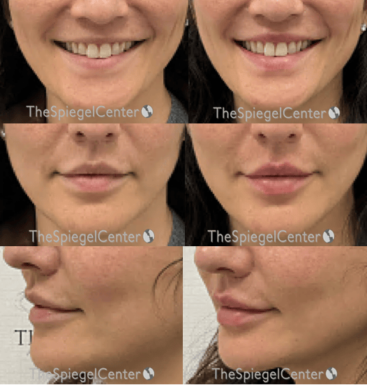 Lip Filler Before & After Gallery - Patient 202802 - Image 1