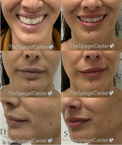 Lip Filler Before & After Gallery - Patient 630942 - Image 1