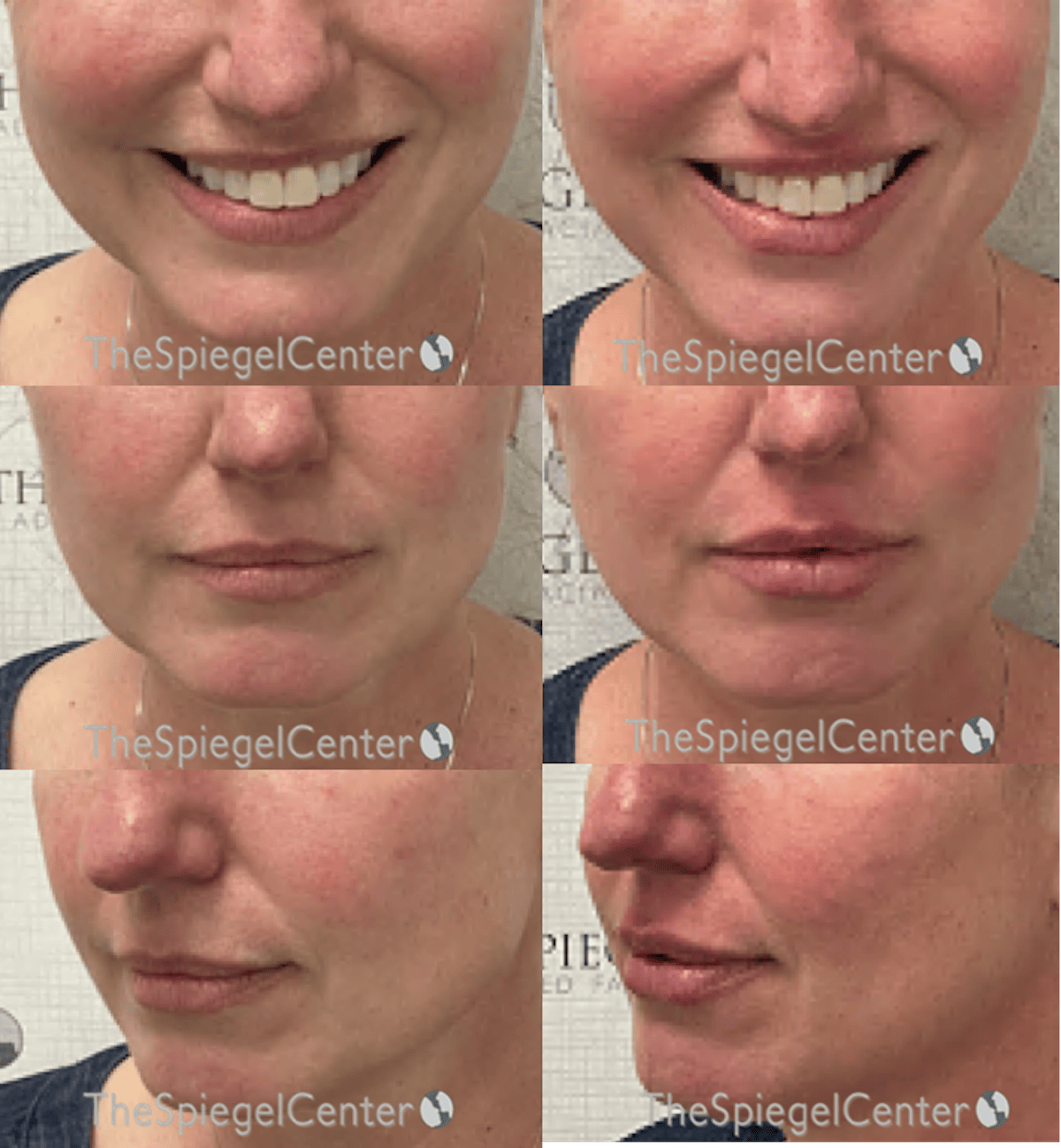 Lip Filler Before & After Gallery - Patient 390979 - Image 1