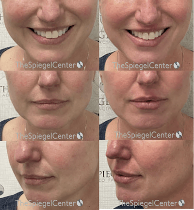 Lip Filler Before & After Gallery - Patient 390979 - Image 1