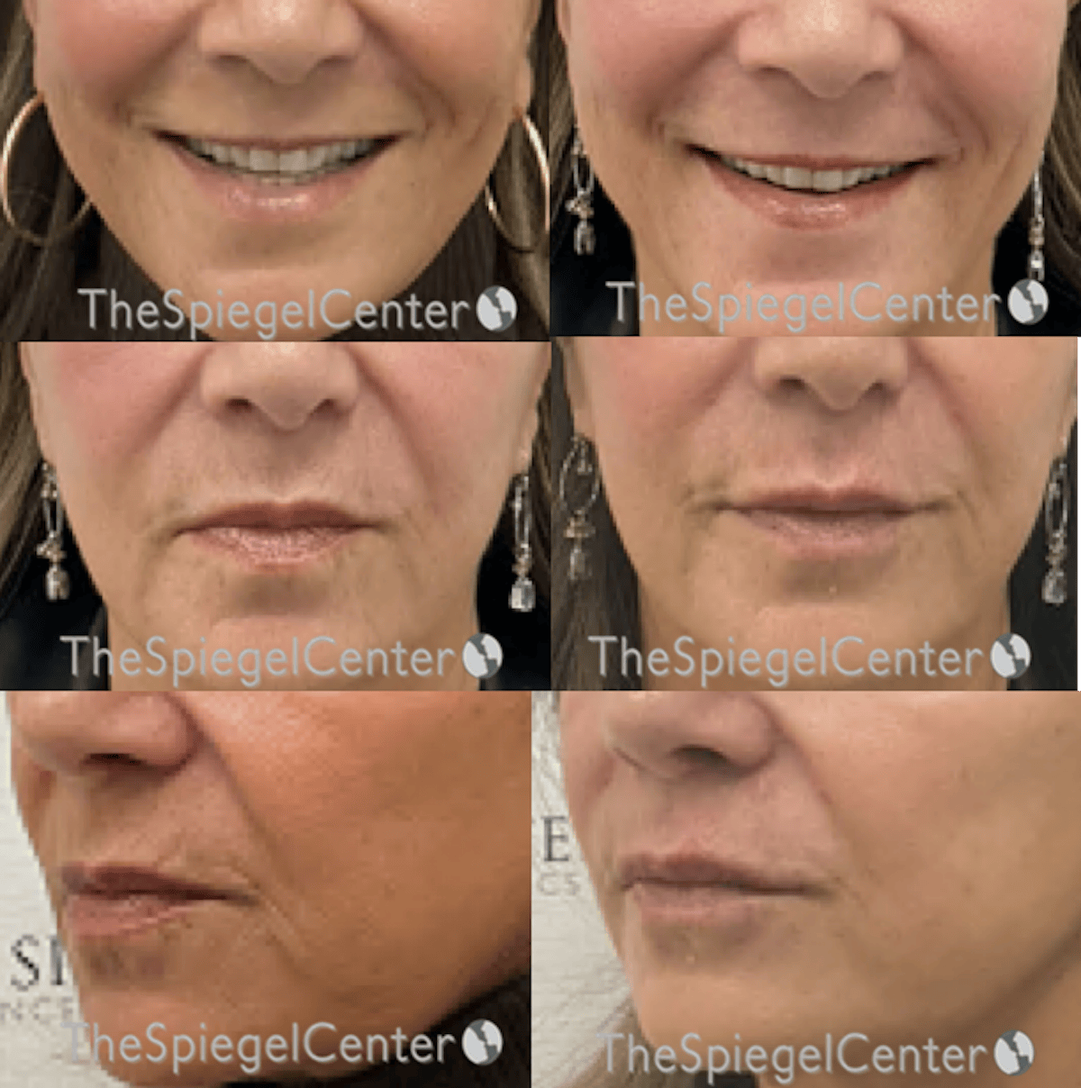 Lip Filler Before & After Gallery - Patient 356828 - Image 1