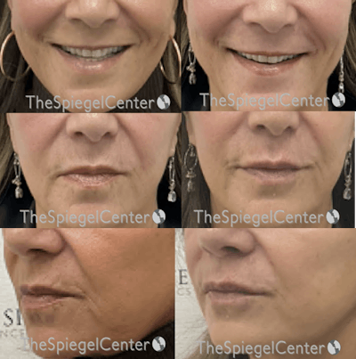 Lip Filler Before & After Gallery - Patient 356828 - Image 1