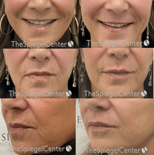 Lip Filler Before & After Gallery - Patient 356828 - Image 1