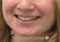 Lip Filler Before & After Gallery - Patient 296004 - Image 1