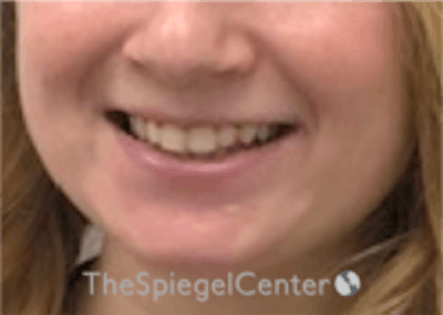 Lip Filler Before & After Gallery - Patient 296004 - Image 1