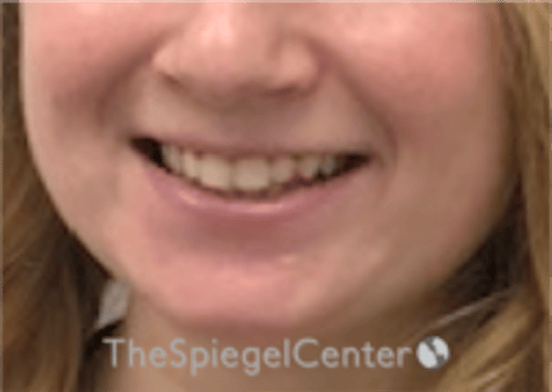 Lip Filler Before & After Gallery - Patient 296004 - Image 1
