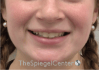 Lip Filler Before & After Gallery - Patient 296004 - Image 2