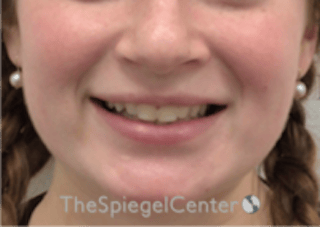 Lip Filler Before & After Gallery - Patient 296004 - Image 2