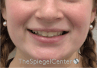 Lip Filler Before & After Gallery - Patient 296004 - Image 2