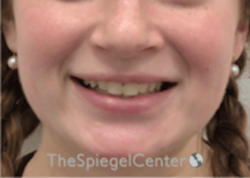 Lip Filler Before & After Gallery - Patient 296004 - Image 2