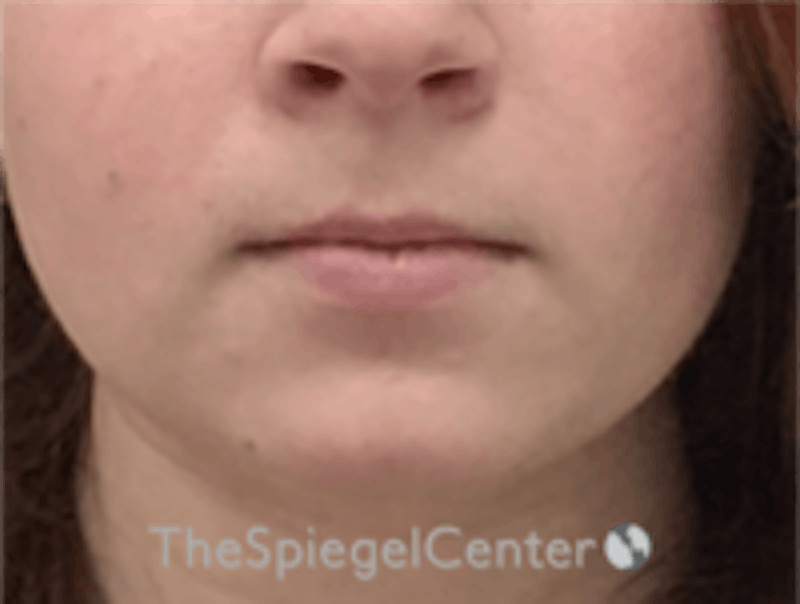 Lip Filler Before & After Gallery - Patient 296004 - Image 3