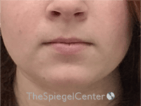Lip Filler Before & After Gallery - Patient 296004 - Image 3