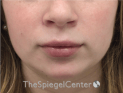 Lip Filler Before & After Gallery - Patient 296004 - Image 4