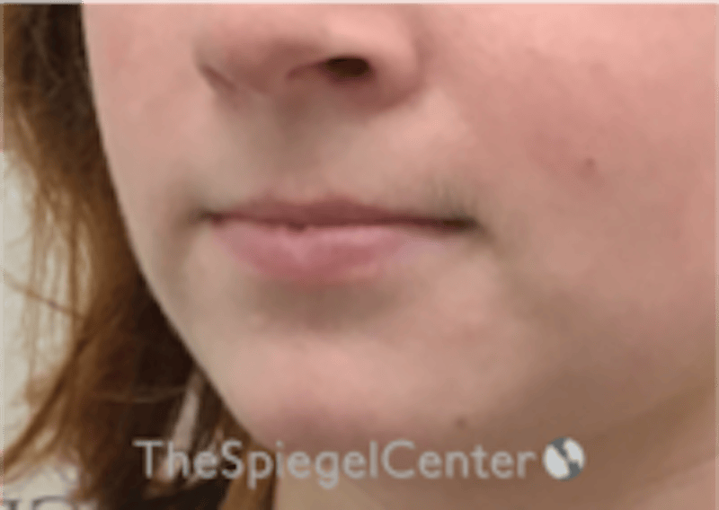 Lip Filler Before & After Gallery - Patient 296004 - Image 5