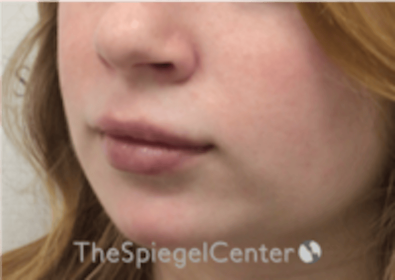 Lip Filler Before & After Gallery - Patient 296004 - Image 6