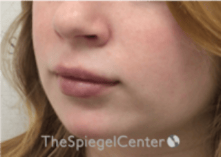 Lip Filler Before & After Gallery - Patient 296004 - Image 6
