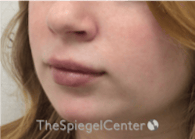 Lip Filler Before & After Gallery - Patient 296004 - Image 6