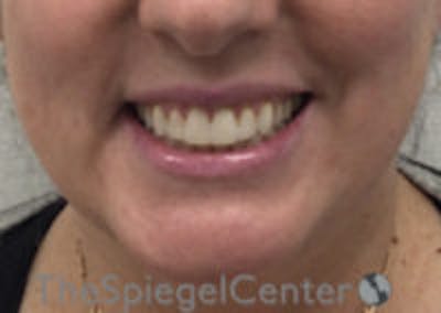Lip Filler Before & After Gallery - Patient 292893 - Image 1