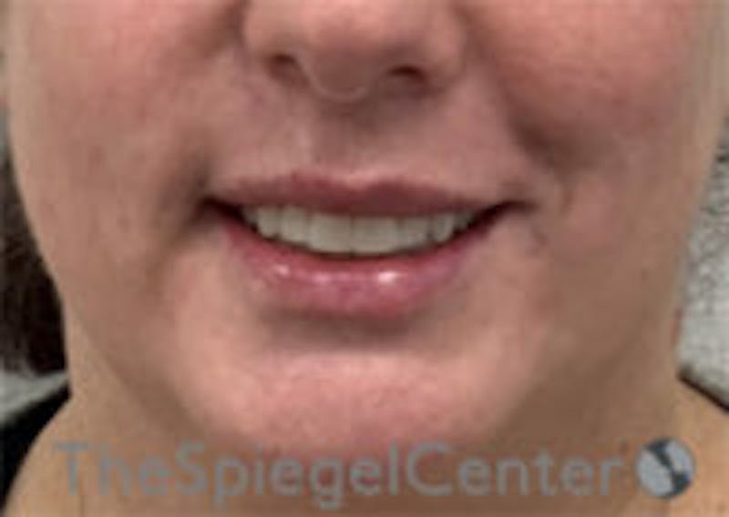 Lip Filler Before & After Gallery - Patient 292893 - Image 2