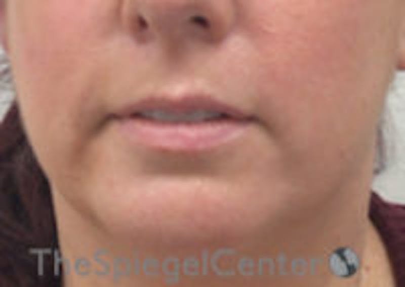 Lip Filler Before & After Gallery - Patient 292893 - Image 3