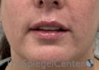 Lip Filler Before & After Gallery - Patient 292893 - Image 4