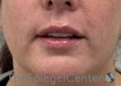 Lip Filler Before & After Gallery - Patient 292893 - Image 4