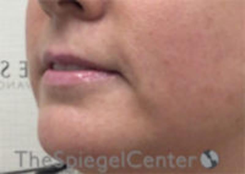 Lip Filler Before & After Gallery - Patient 292893 - Image 5