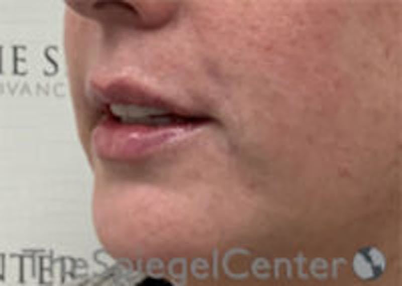 Lip Filler Before & After Gallery - Patient 292893 - Image 6