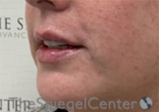 Lip Filler Before & After Gallery - Patient 292893 - Image 6
