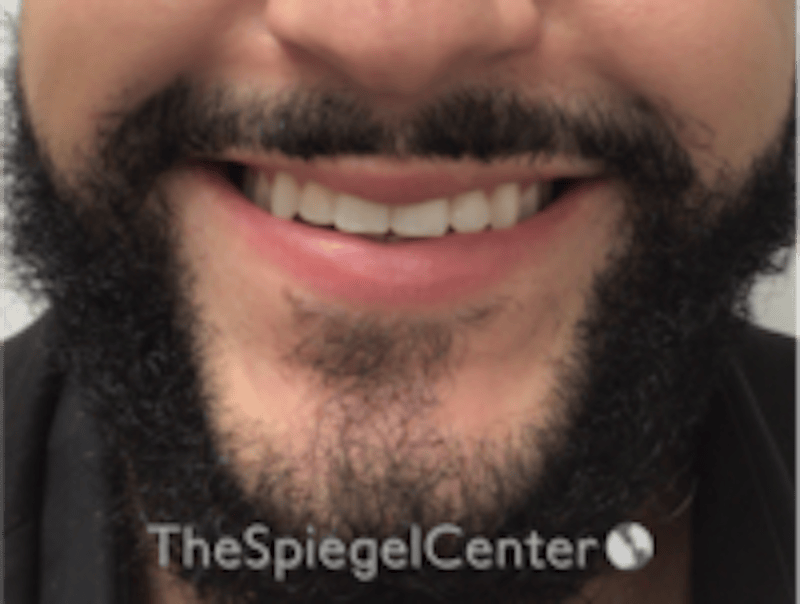 Lip Filler Before & After Gallery - Patient 626156 - Image 1