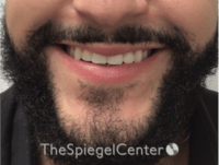 Lip Filler Before & After Gallery - Patient 626156 - Image 1