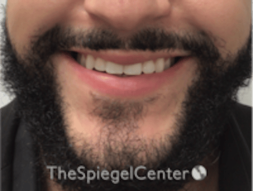Lip Filler Before & After Gallery - Patient 626156 - Image 1