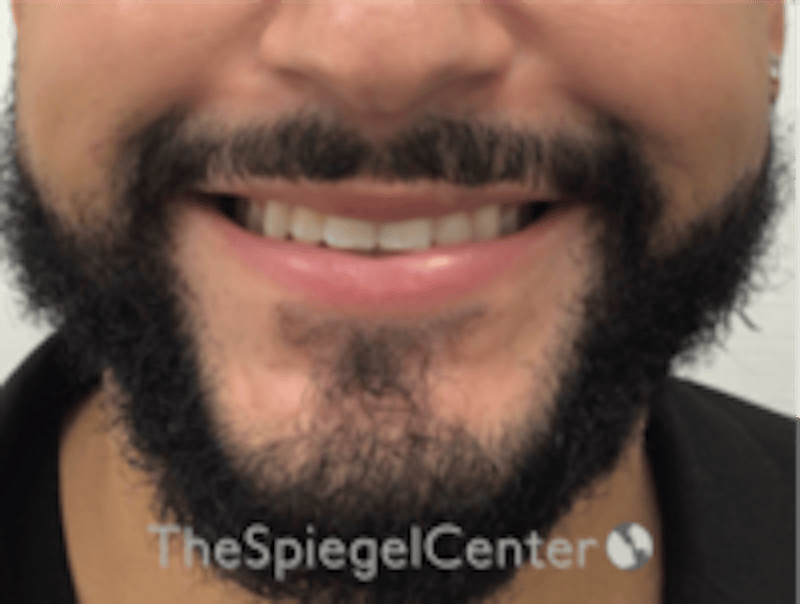 Lip Filler Before & After Gallery - Patient 626156 - Image 2