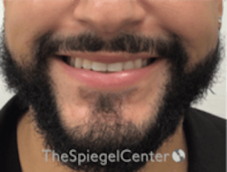 Lip Filler Before & After Gallery - Patient 626156 - Image 2