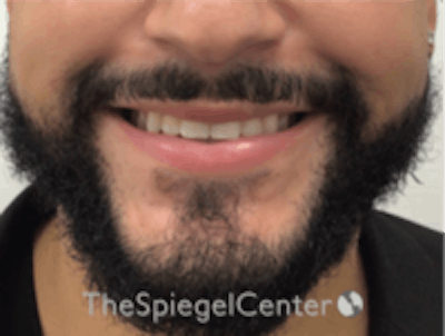 Lip Filler Before & After Gallery - Patient 626156 - Image 2