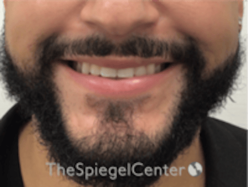 Lip Filler Before & After Gallery - Patient 626156 - Image 2