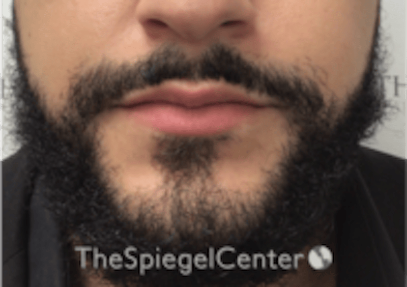 Lip Filler Before & After Gallery - Patient 626156 - Image 3