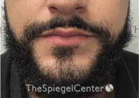 Lip Filler Before & After Gallery - Patient 626156 - Image 3