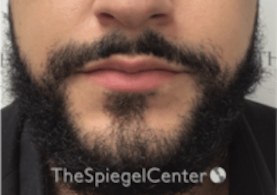 Lip Filler Before & After Gallery - Patient 626156 - Image 3