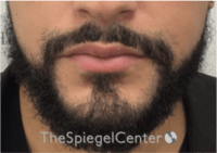 Lip Filler Before & After Gallery - Patient 626156 - Image 4