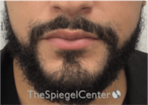 Lip Filler Before & After Gallery - Patient 626156 - Image 4