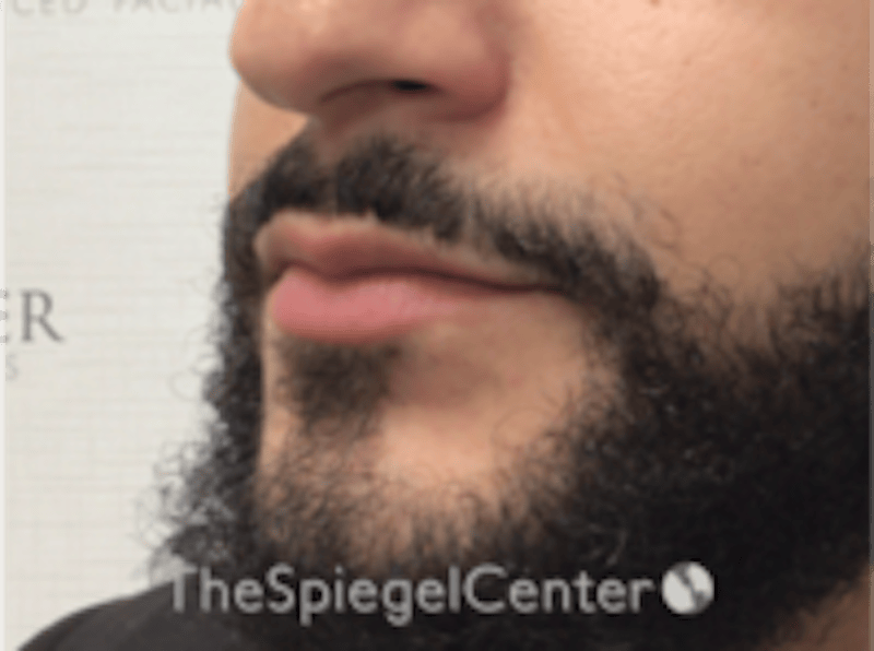 Lip Filler Before & After Gallery - Patient 626156 - Image 5