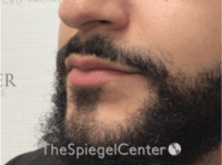 Lip Filler Before & After Gallery - Patient 626156 - Image 5