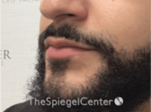 Lip Filler Before & After Gallery - Patient 626156 - Image 5