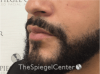 Lip Filler Before & After Gallery - Patient 626156 - Image 6