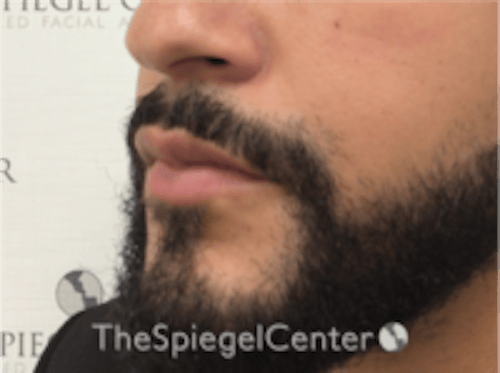 Lip Filler Before & After Gallery - Patient 626156 - Image 6